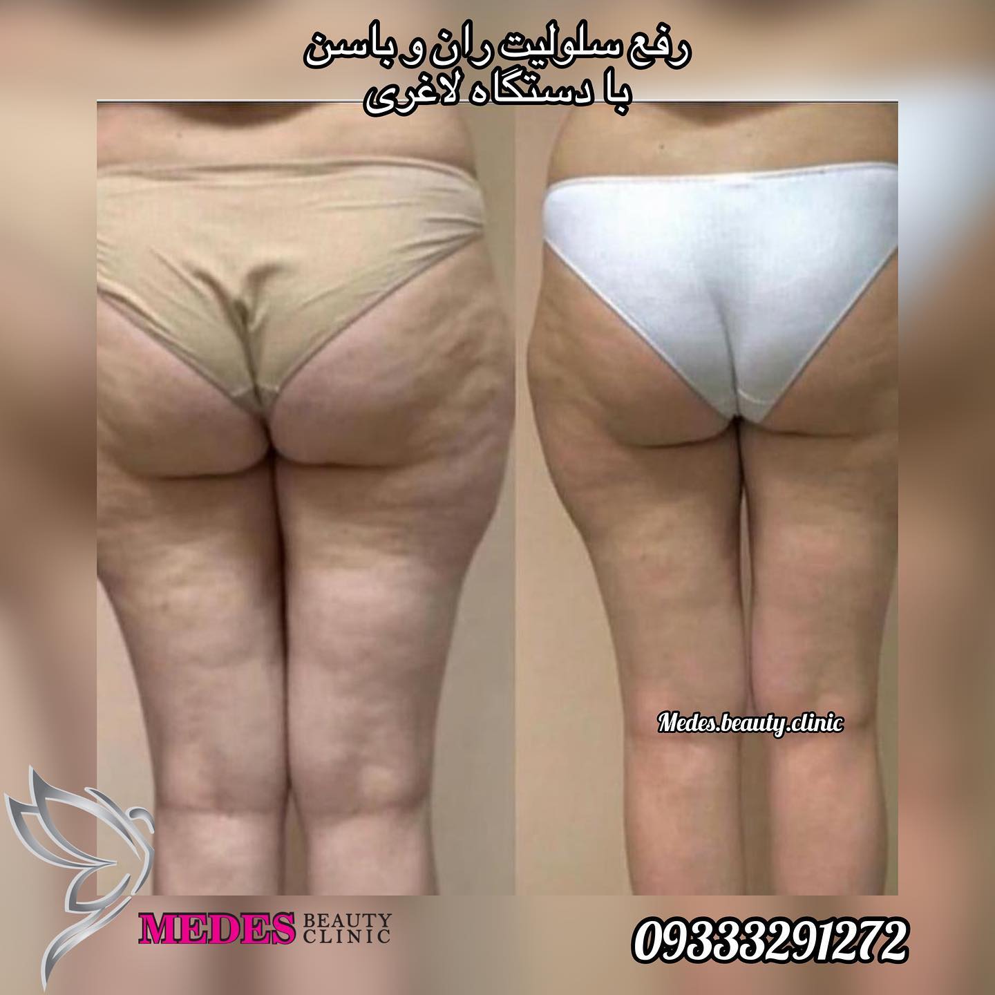 گالری لاغری با دستگاه